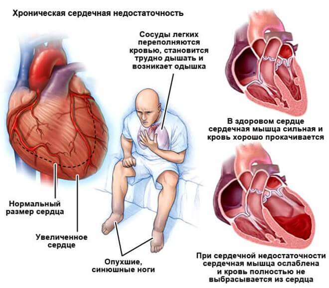 Может ли остановиться сердце. Клинические проявления хронической сердечной недостаточности. ХСН хроническая сердечная недостаточность симптомы. Фенотипические проявления острой сердечной недостаточности:. Сердечная недостаточно.